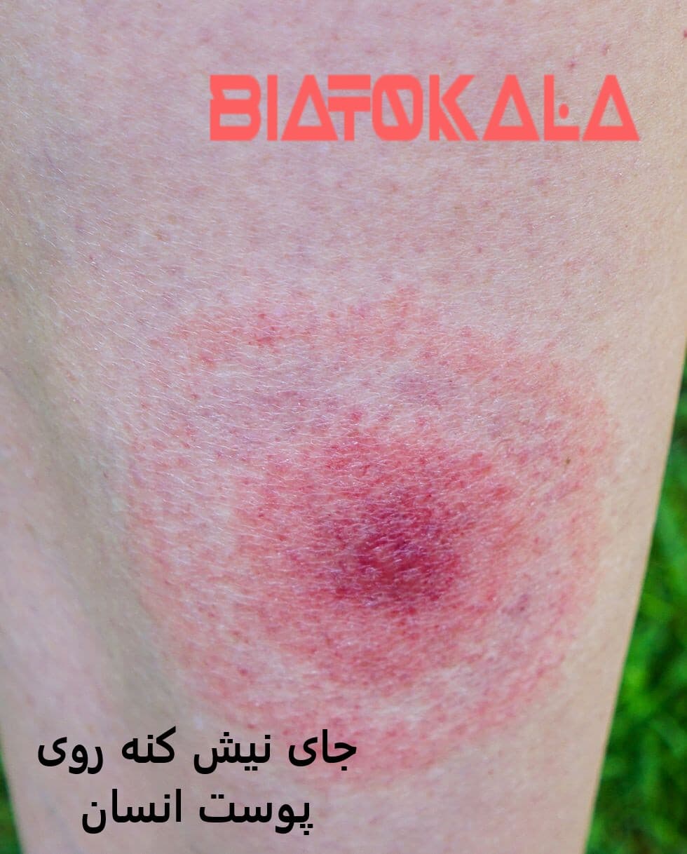 جای نیش کنه روی پوست انسان 